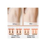 Gaman Buz Lazer Epilasyon 999.999 Atım- Cilt Onarıcı - Lazer Epilasyon Aleti ( Jilet + Gözlük Hediye ) - Görsel 5